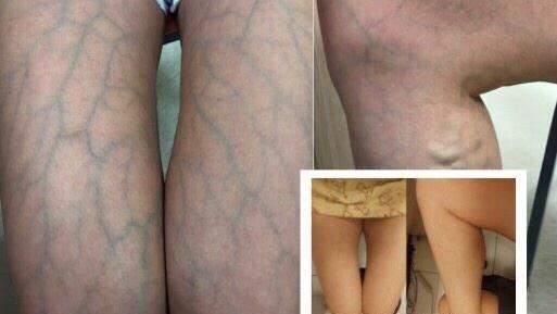 女「藍色蜘蛛網」佈滿雙腿…原因曝光