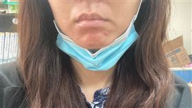 青春痘(南投醫院提供)