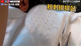 粉刺排排站。（圖／Ines 宜內斯臉書授權）