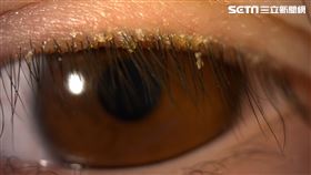 嚇！家政婦雙眼紅爆癢　一照眼睫毛竟爬滿蠕形蟎蟲（圖／亞大醫院提供）