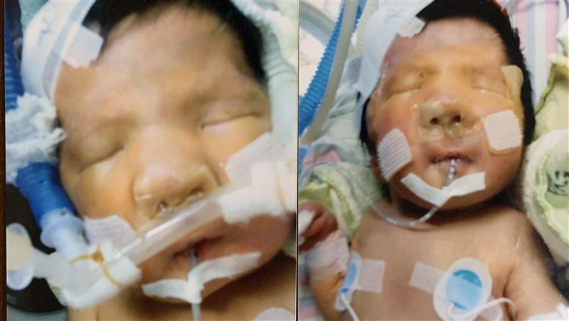 全台唯一罕病童　開刀13次撐開手腳