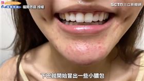 ▲福爾思庭透露日前去清粉刺，結果肌膚竟然長出許多有膿的暗瘡。（圖／福爾思庭 授權）