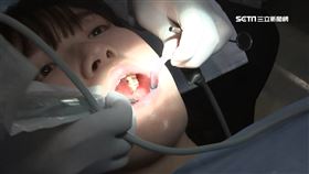 驚！牙縫卡菜渣形成牙結石　醫師警告：錯誤清潔恐越剔越髒