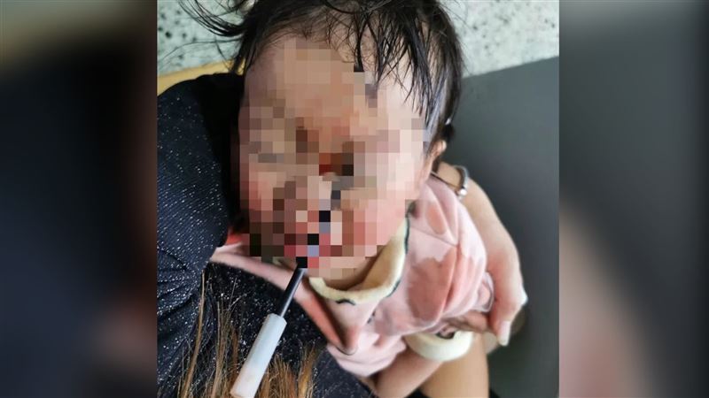 這爆紅玩具插入眼睛　3歲女顱腦受損