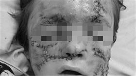 美國,比特犬,男童,咬傷,臉（圖／翻攝gofundme）