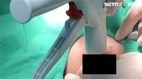 亞東醫院,小兒外科,夏肇聰,包皮,包皮環切手術（圖／亞東醫院提供）