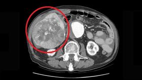 肝癌,中草藥,腫瘤,大千綜合醫院,肝膽腸胃科,林裕鈞,心肌梗塞