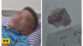 江西,南昌,咳嗽,豬骨,手術（圖／翻攝自梨視頻）