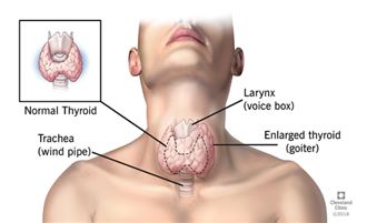 18歲高中女生沒怎樣竟得甲狀腺癌