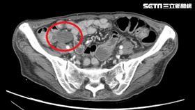 闌尾塞腫瘤不知　60歲女狂拉肚子10年、體重剩37公斤（圖／台中慈院提供）