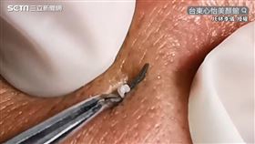 ▲網路上瘋傳許多擠粉刺影片，吸引無數網友觀看。（圖／JE林季儀 授權）