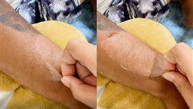 脫皮,曬傷,屬蛇,療癒(翻攝自 爆廢公社)