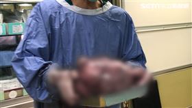 未婚無性行為　美魔女竟養出如1歲嬰、10公斤大肌瘤（圖／光田綜合醫院提供）