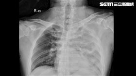 台北慈濟醫院胸腔外科主任程建博醫師依據家屬描述及影像檢查，診斷為「自發性食道破裂」（圖／台北慈院提供）