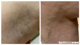 靜脈曲張(讀者提供)