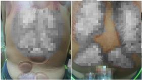 「癌症都能治！」阿伯信民俗療法…衣服一脫網看傻：快送醫（圖／翻攝自爆怨公社）