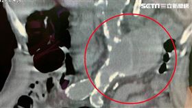 大千綜合醫院心臟外科主任楊智鈞醫師表示，腹主動脈瘤就像是體內的未爆彈，除了可以從躺著時摸肚子感覺「有一顆球在跳」之外，幾乎沒有其他症狀。（圖／大千綜合醫院提供）

