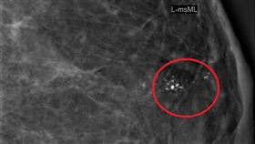 烏日林新醫院,乳房外科,吳玉婷,超音波,鈣化,乳房X光,乳癌
圖/烏日林新醫院提供
