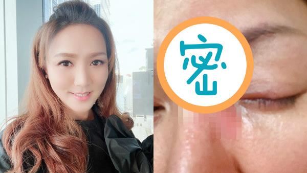 臉上驚現「蛇」遭酸　挺共女星怒開嗆