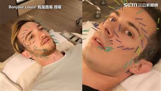 百根針扎臉　法人針灸初體驗嚇傻