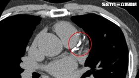 冠狀動脈電腦斷層攝影檢查發現「左前降支冠狀動脈」嚴重阻塞（圖／亞大醫院提供）