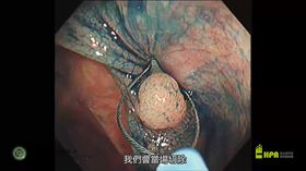 大腸癌（截圖自國健署影片）