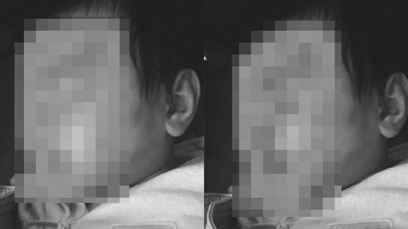 獨／台中驚傳虐嬰？5月嬰腋下大片傷