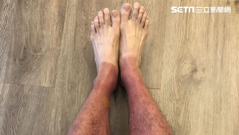 獨木舟划4小時　45歲男腿曬成紫芋