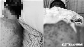 17歲獨子染SJS　自己拔管等待死亡...父母淚：什麼病沒藥醫？／家屬提供