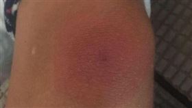 德琳膝蓋的傷口越來越腫，顏色變深。（圖／翻攝自麗莎臉書）