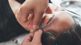 名家專用／NOW健康／美顏針以不動刀的方式，順應人體穴位溫和修飾臉型自然不著痕跡。(勿用)