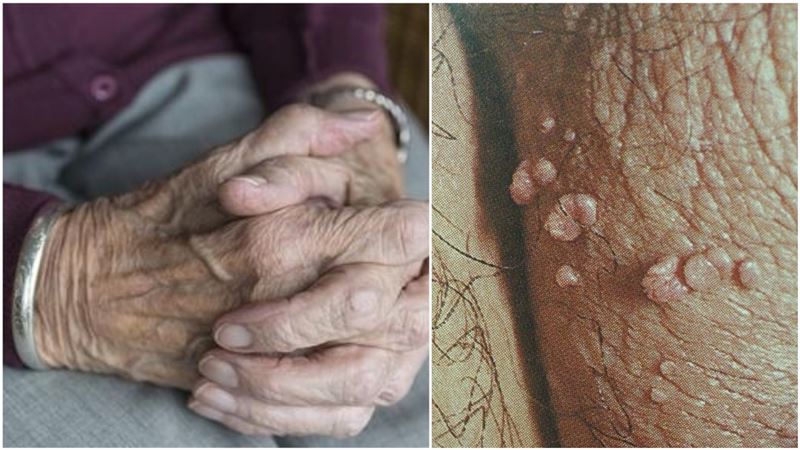 喪偶10年得菜花！醫還70歲嬤清白