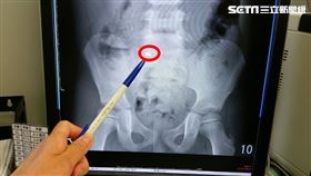 韓舒萍醫師表示，根據研究顯示，六個月到六歲是孩童吞食異物最常發生的年紀（圖／長安醫院提供）