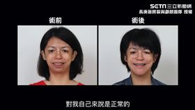 ▲罹患了TCS的長昕，分享自己的成長歷程。（圖／長庚唇腭裂與顱顏團隊 授權）