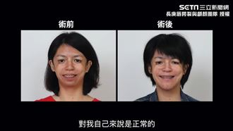 顱顏缺陷遭譏笑　女孩正顎獲新生