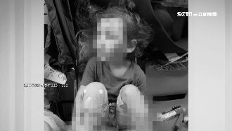 臉瘀青腳骨折　民眾怒揪繼父狠虐女童