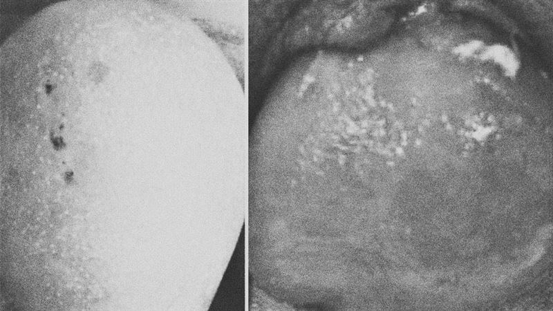 3症狀出現　肛門恐「玫瑰花盛開」