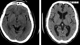 家有3位失智症患者　女憂心問：我會不會也一樣？（圖／安南醫院提供）