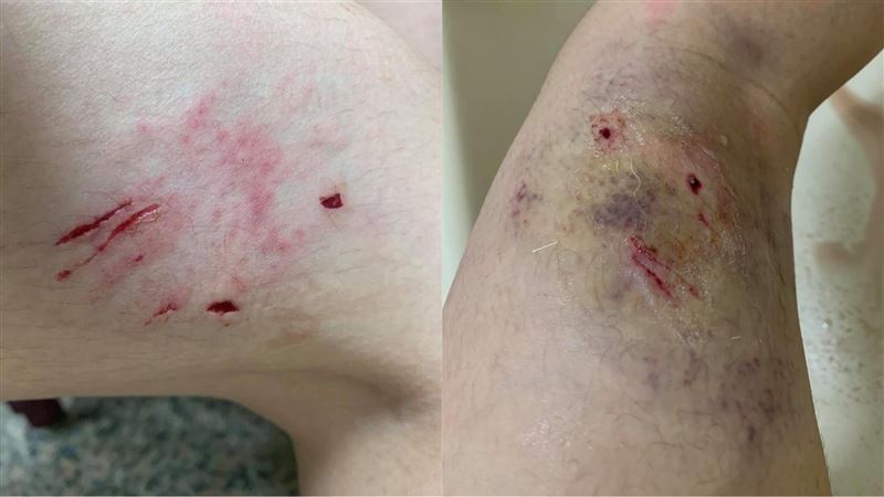 被民宿養的狗咬傷　老闆竟回算你衰