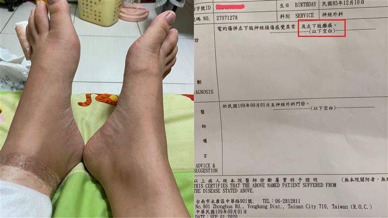 連鎖火鍋店電磁爐爆　妙齡女被炸癱瘓