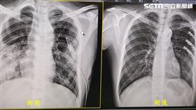 神！20男大生機車車禍肋骨骨折血胸險死　一個月後可打球（圖／童綜合醫院提供）
