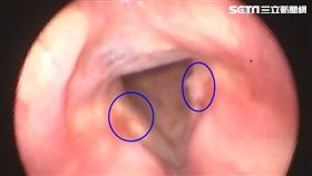 胃酸逆流致喉部接觸性肉芽腫（圖／亞大醫院提供）