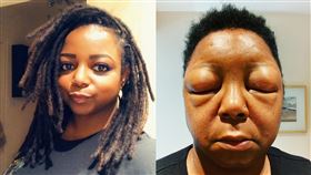 染髮隔夜腫成豬頭！女：別跳過這一步
加拿大,染髮,過敏,Sherrie Virtue,貼布試驗,patch test
翻攝自Sherrie IG