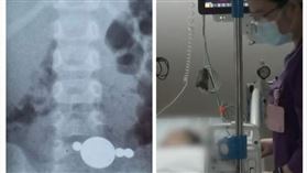 中國,深圳,女童,誤吞,異物,腸管,手術（圖／翻攝自梨視頻）