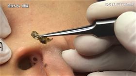 美容師夾出耳內驚人鐘乳石　3洞黑頭粉刺整組摘除超爽