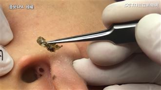 夾出驚人鐘乳石　黑頭粉刺摘除超爽