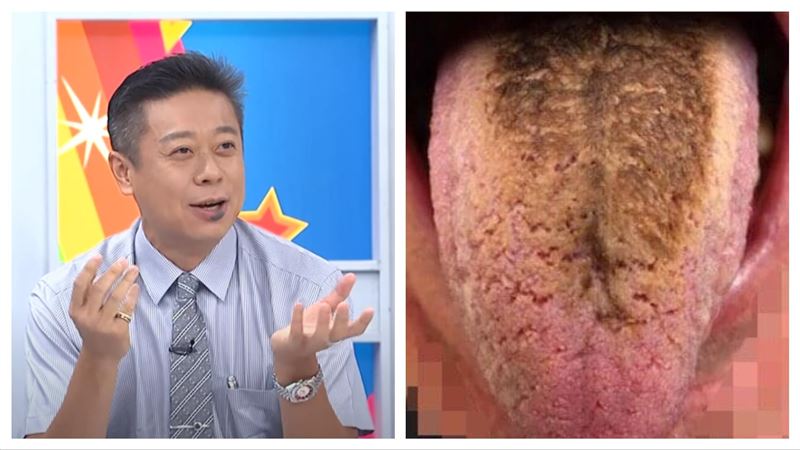 中年男作息差　舌頭竟變「恐怖顏色」