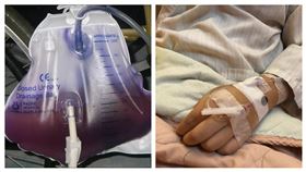 紫色尿袋症候群（台北榮總鳳林分院授權）