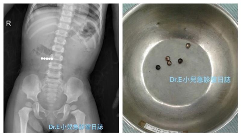 滑倒就醫　驚見5顆「白亮球形異物」
