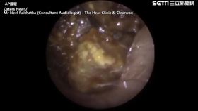 ▲醫生挖出巨大耳垢。（圖／AP/Caters TV授權）